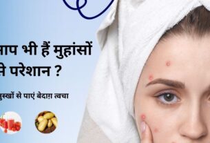 मुहांसों के लिए घरेलु नुस्खे